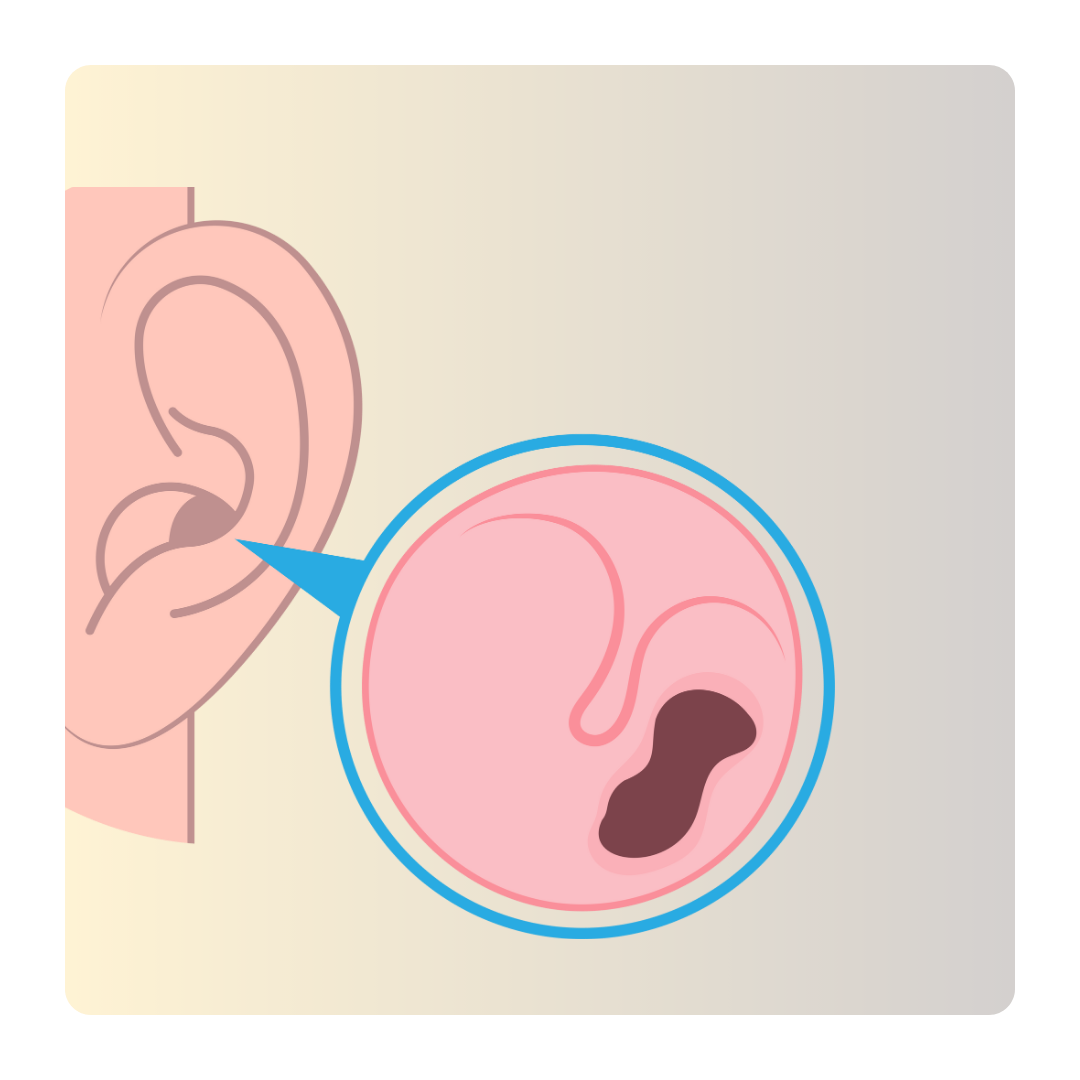 Conductive Hearing Loss - Earwax buildup