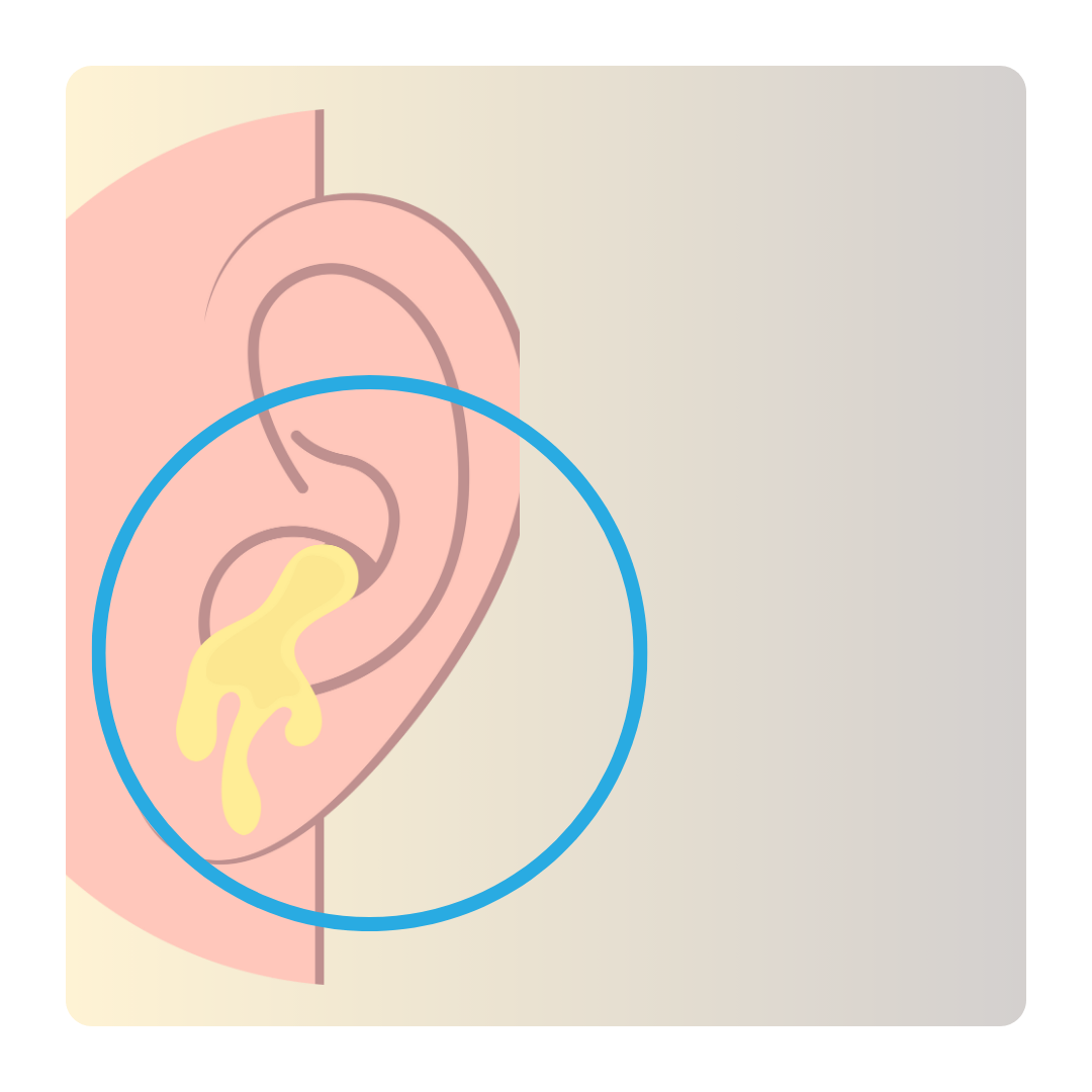 Conductive Hearing Loss - Fluid in the canal - external infection