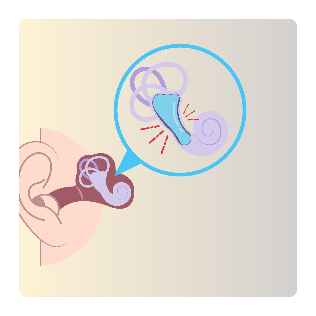 Conductive Hearing Loss - Middle Ear Infection